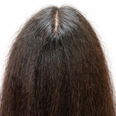 Before - Emily R, 32 Years Old